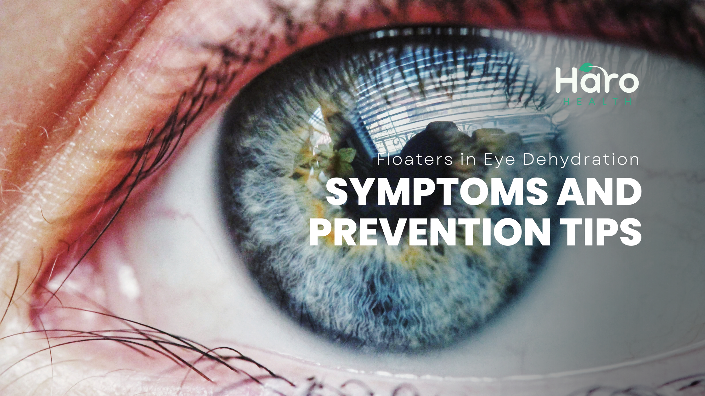 Floaters in Eye Dehydration: Symptoms and Prevention Tips