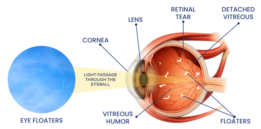 Original eye cross-section showing cornea, lens, vitreous humor, floaters and the light pathway, with a retinal tear and detached vitreous also labeled.